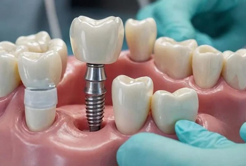 Dental-Implants Dental-Implants